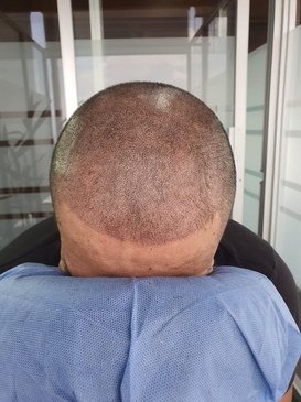Slider image (5) SMP Advanced - Scalp Micro Pigmentation